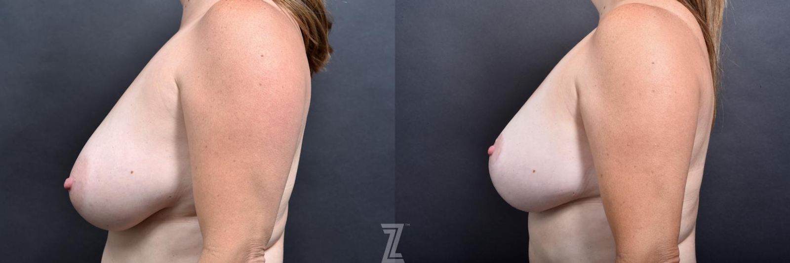 Austin Breast Lift Before & After Gallery - Patient 132791077 - Image 3 - The Piazza Center