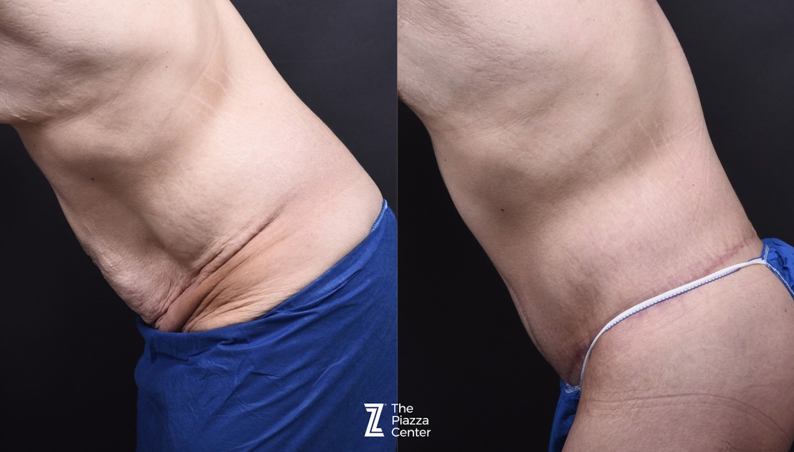 Austin Male Body Contouring Before & After Gallery - Patient 374227 - Image 5 - The Piazza Center