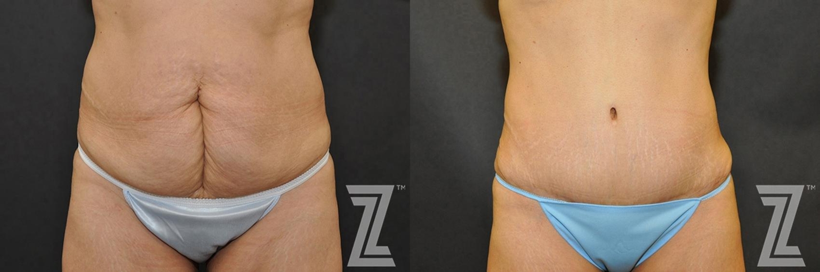 Austin Tummy Tuck Before & After Gallery - Patient 132886902 - Image 1 - The Piazza Center