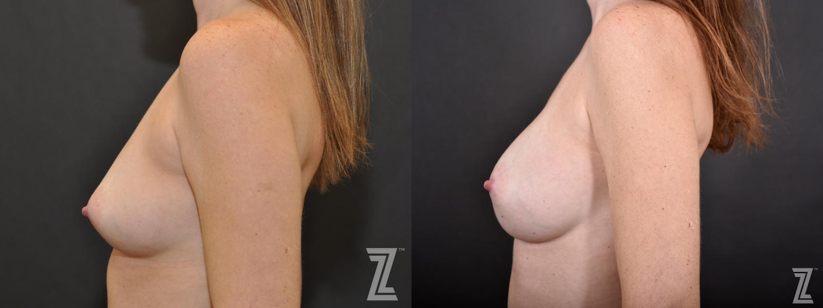 Austin Lateral View of before and after 33 year old women with Silicone Implants with Cohesive Silicone Gel at the Piazza center - The Piazza Center