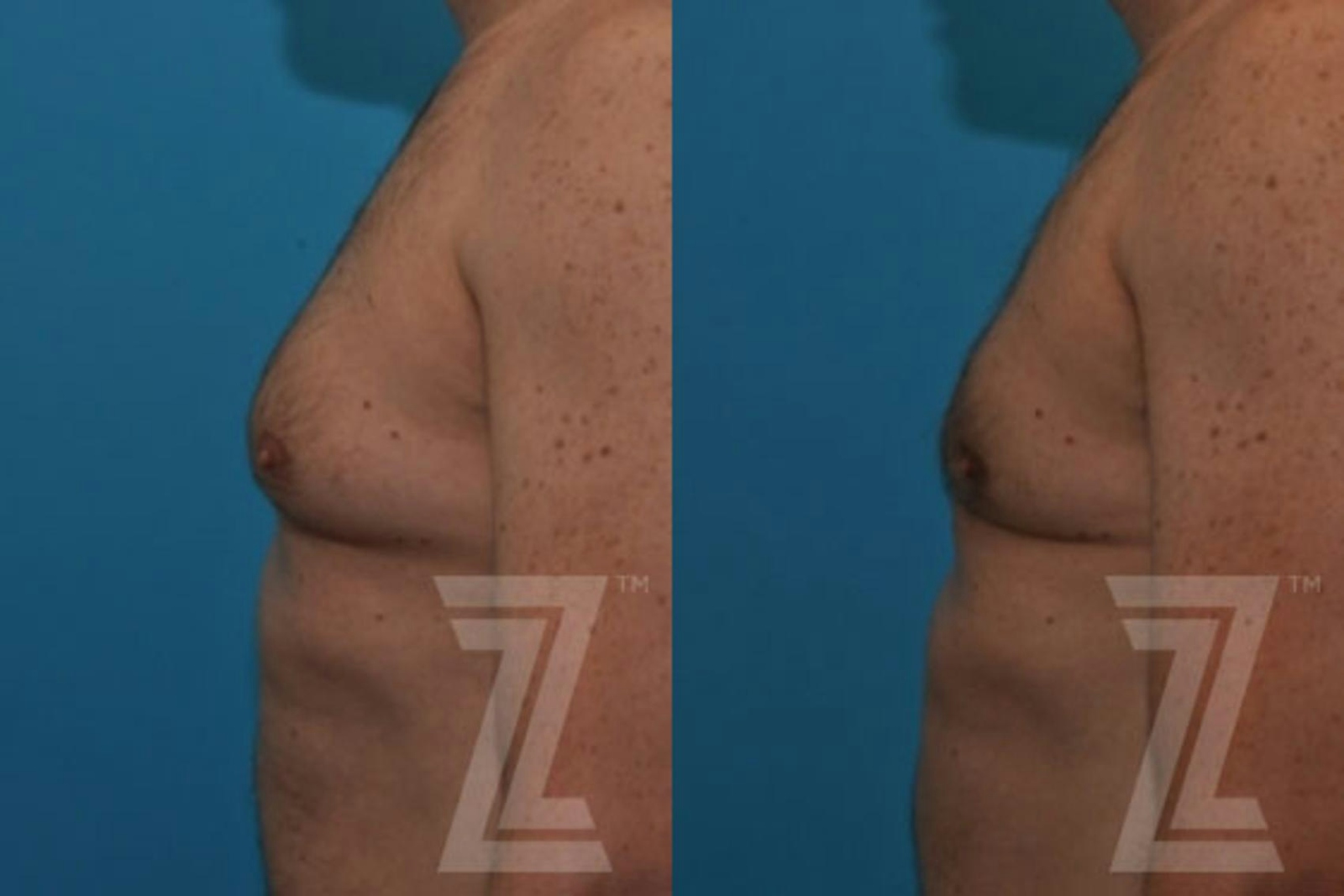 Austin Male Breast Reduction Before & After Gallery - Patient 132963592 - Image 1 - The Piazza Center