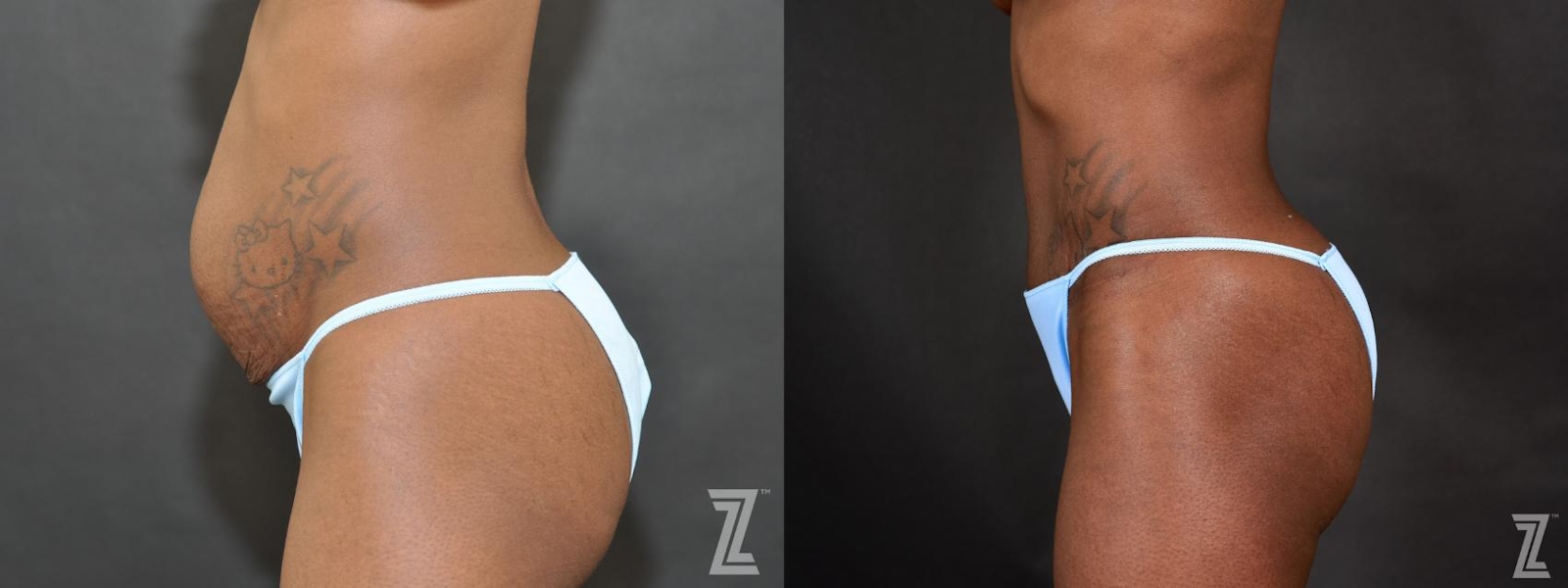 Austin Tummy Tuck Before & After Gallery - Patient 132886804 - Image 2 - The Piazza Center
