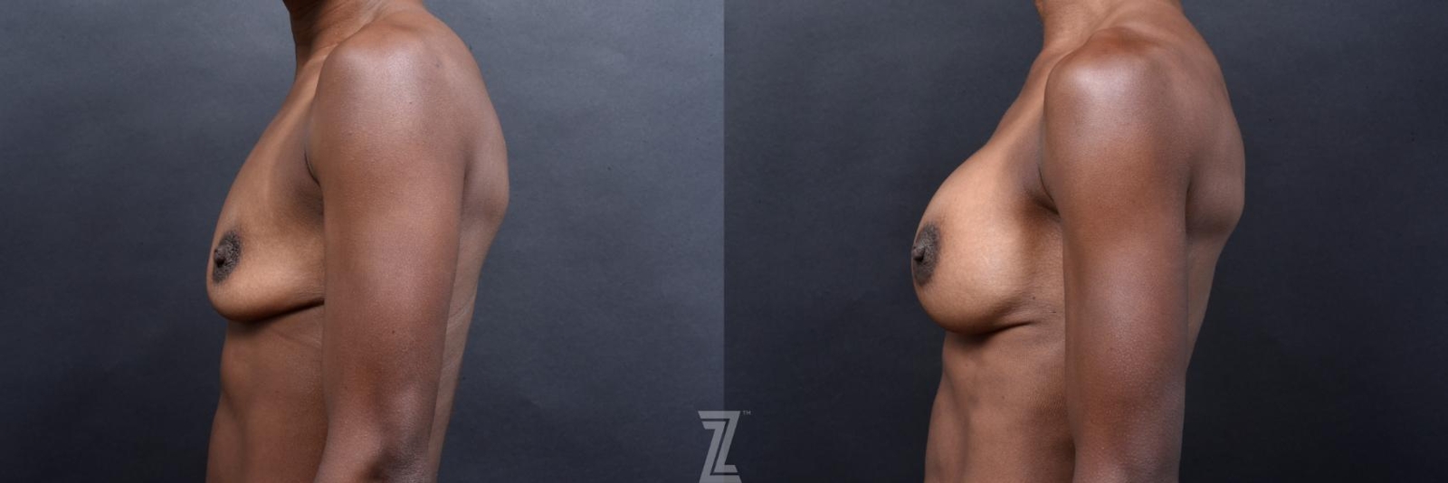 Austin side view of before and after view of 33 year old athletic mom of two children breast augmentation - The Piazza Center