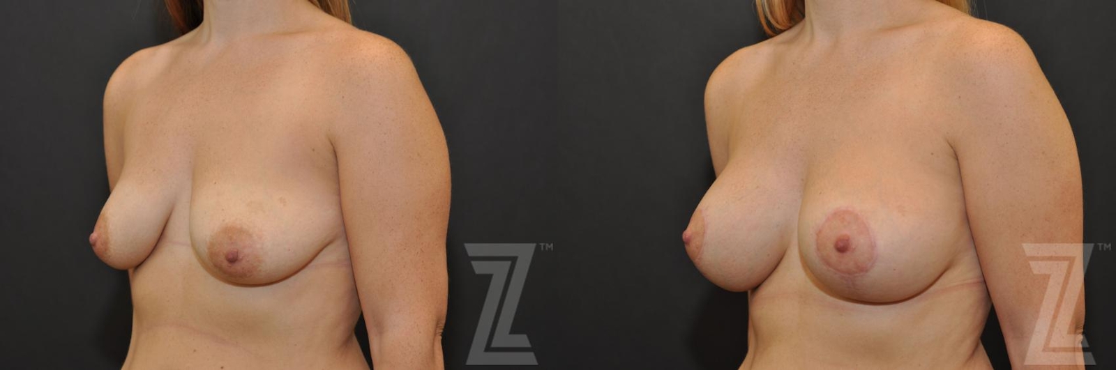 Austin Breast Augmentation With a Breast Lift Before & After Gallery - Patient 132791094 - Image 2 - The Piazza Center