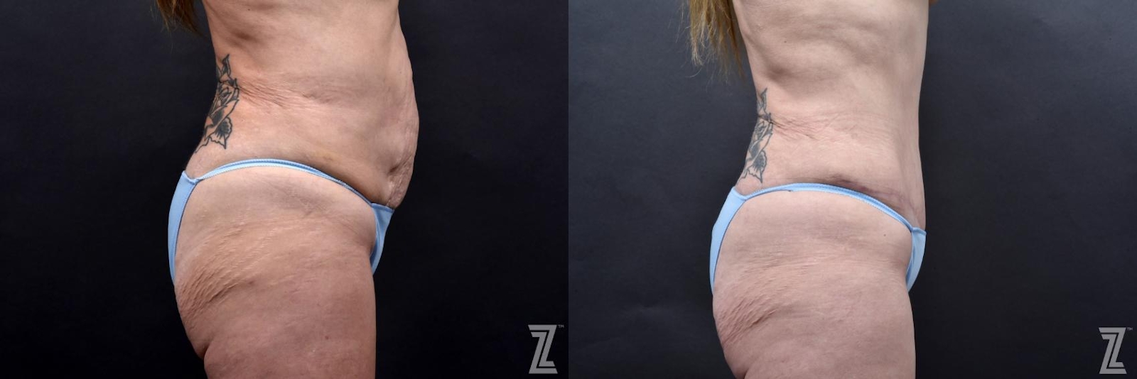 Austin Tummy Tuck Before & After Gallery - Patient 132886812 - Image 4 - The Piazza Center