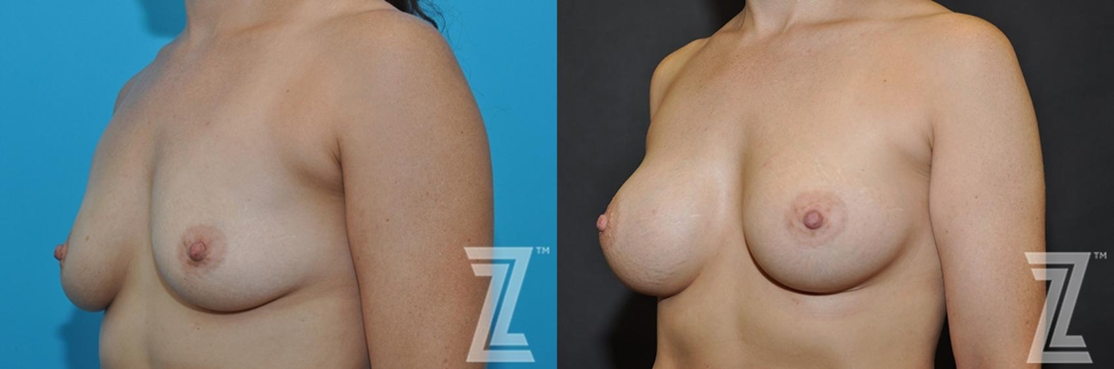Austin Oblique View before & after images of 33 year old woman with breast augmentation - The Piazza Center - The Piazza Center