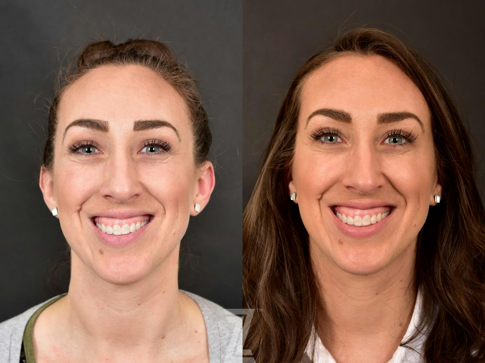 Austin Injectable Fillers Before & After Gallery - Patient 132963104 - Image 2 - The Piazza Center