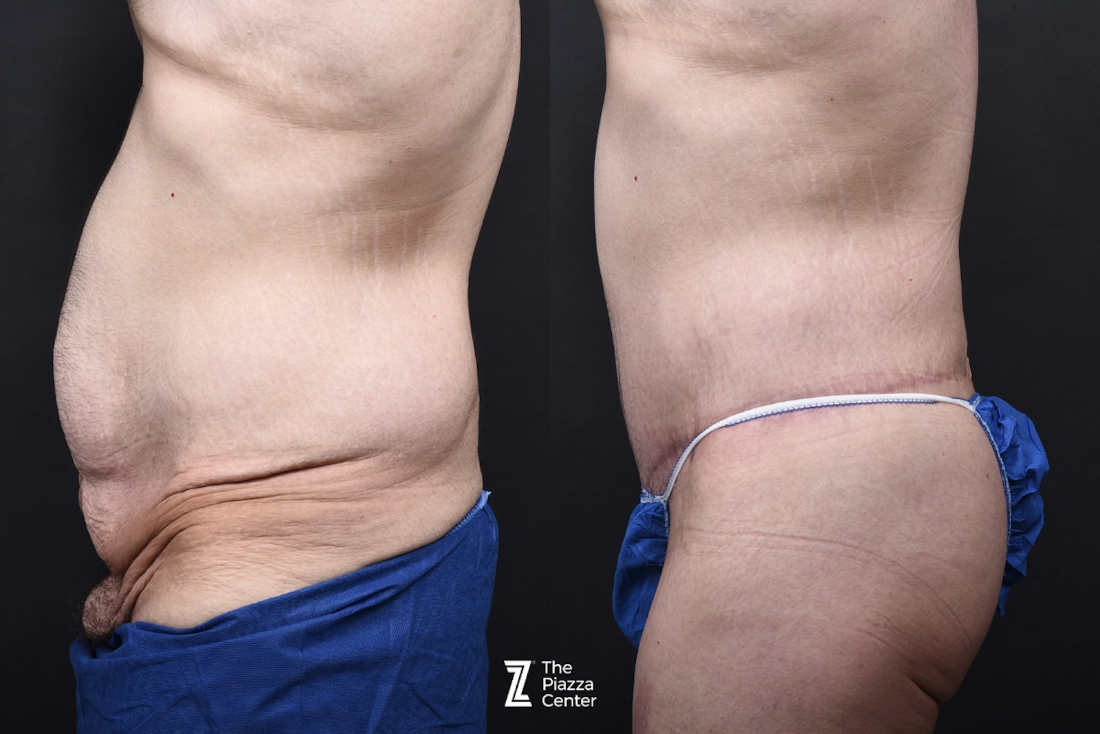Austin Tummy Tuck Before & After Gallery - Patient 346471 - Image 4 - The Piazza Center