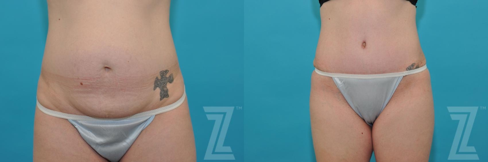 Austin Tummy Tuck Before & After Gallery - Patient 132886890 - Image 2 - The Piazza Center