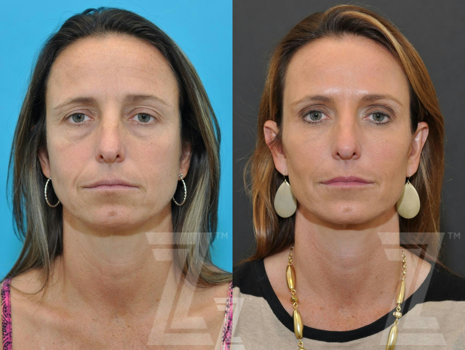 Austin Facial Rejuvenation Before & After Gallery - Patient 326782 - Image 1 - The Piazza Center