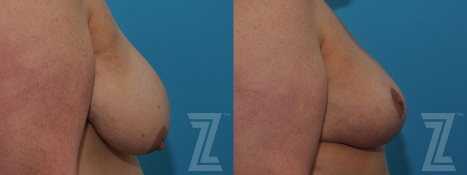 Austin Breast Reduction Before & After Gallery - Patient 132886599 - Image 5 - The Piazza Center