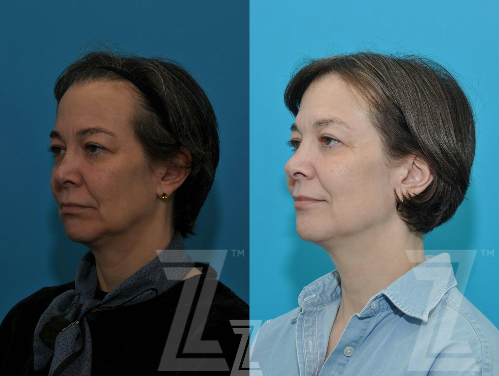 Austin Sculptra® Before & After Gallery - Patient 132963131 - Image 2 - The Piazza Center