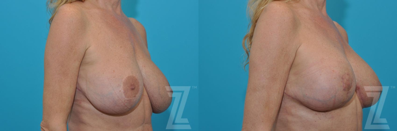 Austin Breast Augmentation Revision Before & After Gallery - Patient 132886579 - Image 4 - The Piazza Center