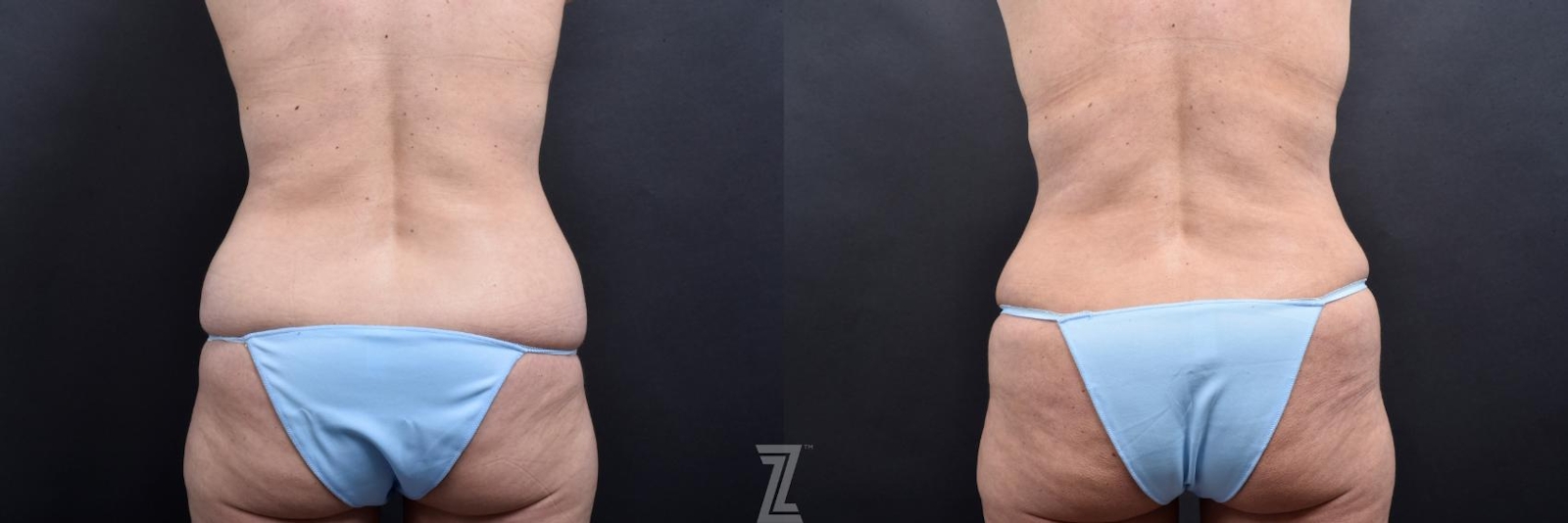 Austin Posterior View from Mommy Makeover of 41 year old woman in Austin, TX by Dr. Rocco Piazza - Before & After - The Piazza Center