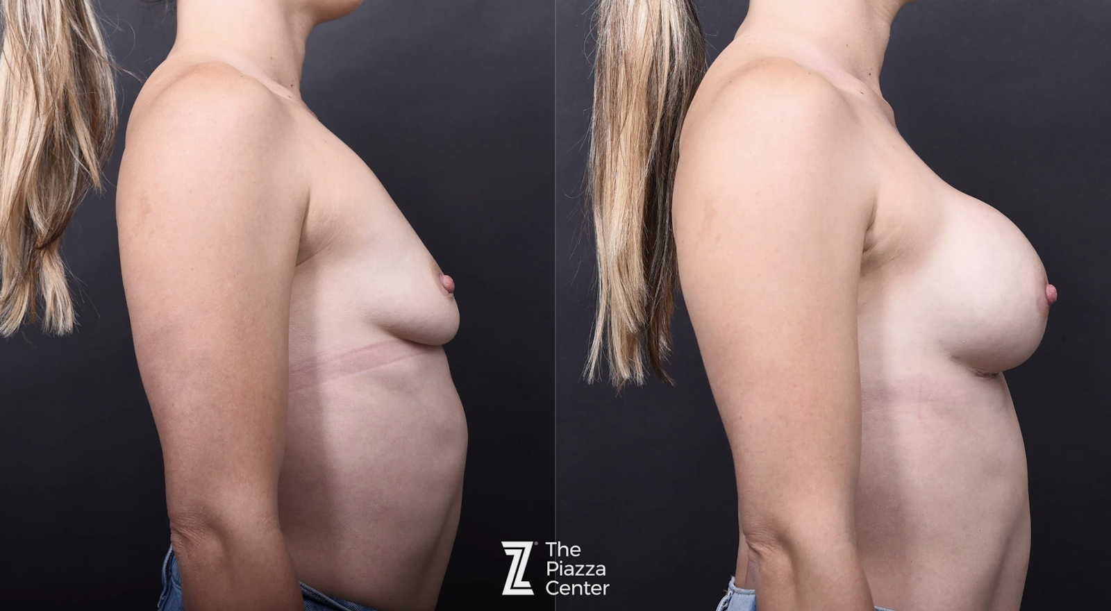 Austin Motiva Preservé/Breast Tissue Preservation Before & After Gallery - Patient 336776 - Image 3 - The Piazza Center