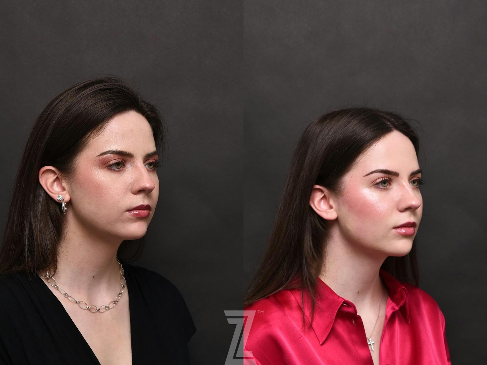 Austin Injectable Fillers Before & After Gallery - Patient 132963119 - Image 3 - The Piazza Center