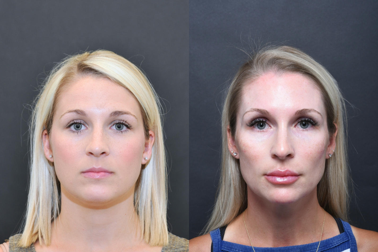 Austin Injectable Fillers Before & After Gallery - Patient 404245 - Image 1 - The Piazza Center