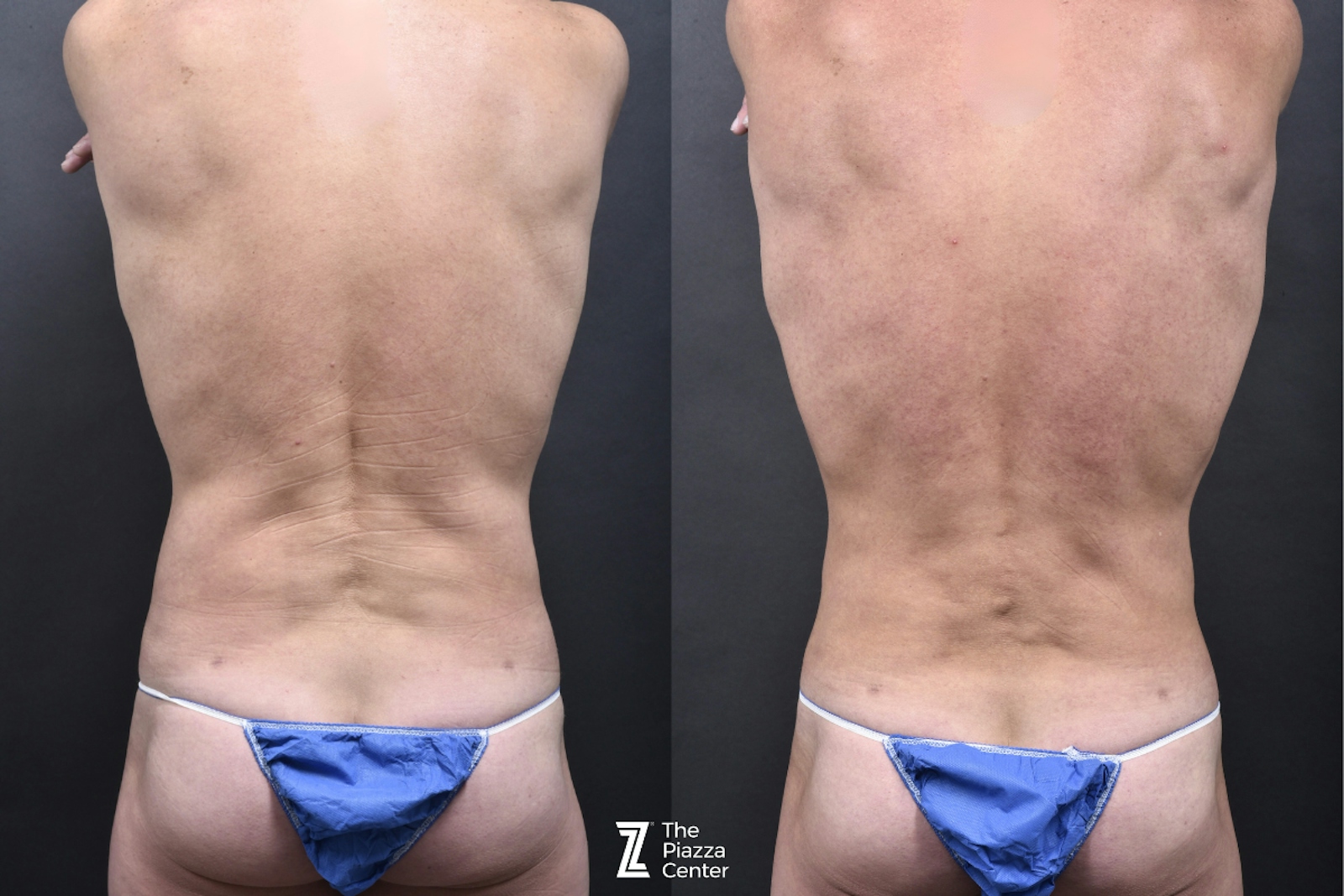 Austin Male Body Contouring Before & After Gallery - Patient 219361 - Image 4 - The Piazza Center