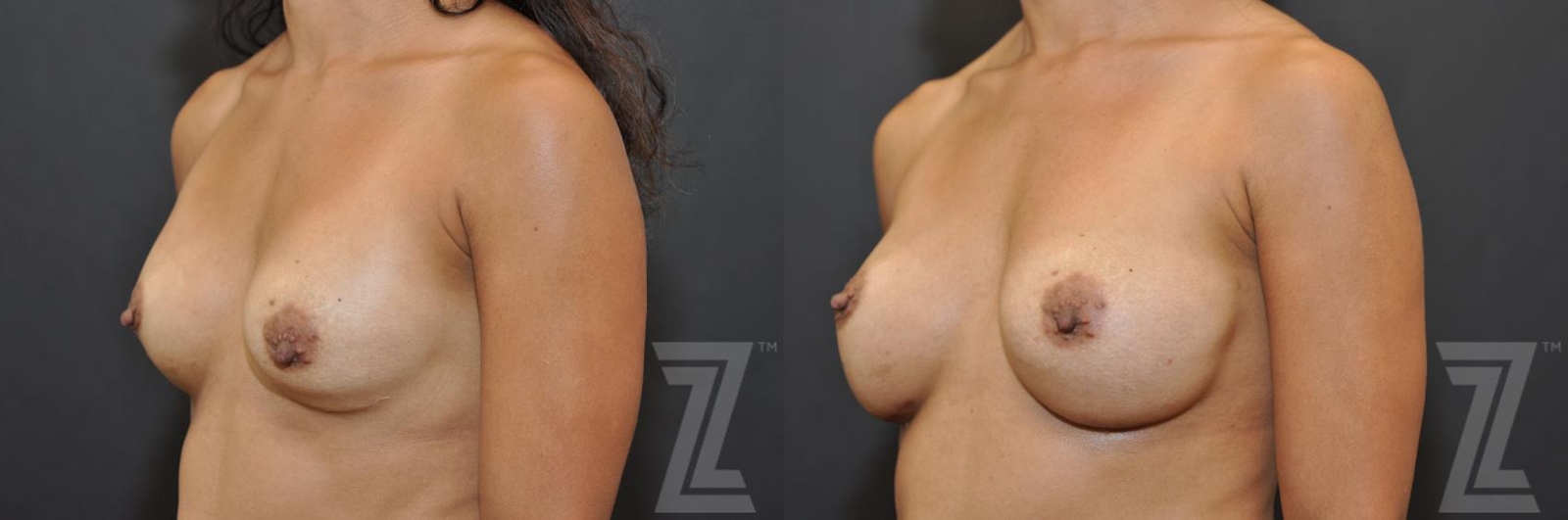 Austin Breast Augmentation Revision Before & After Gallery - Patient 132886551 - Image 2 - The Piazza Center