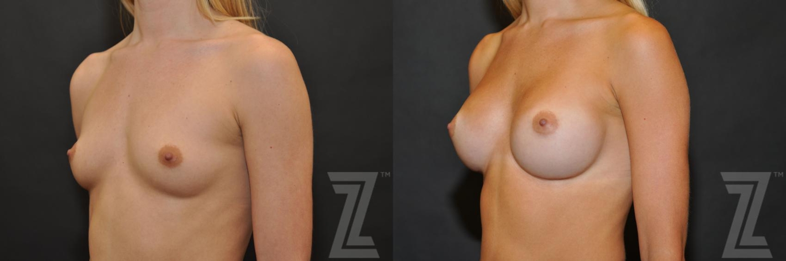 Austin oblique view of 27 year old woman before and after breast augmentation - The Piazza Center