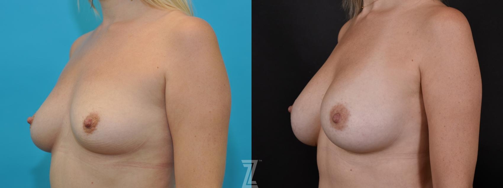 Austin 5 year post op oblique view before & after images of 35 year old woman with Silicone Implants with Highly Cohesive Gel (Gummy Bear Implants) - The Piazza Center