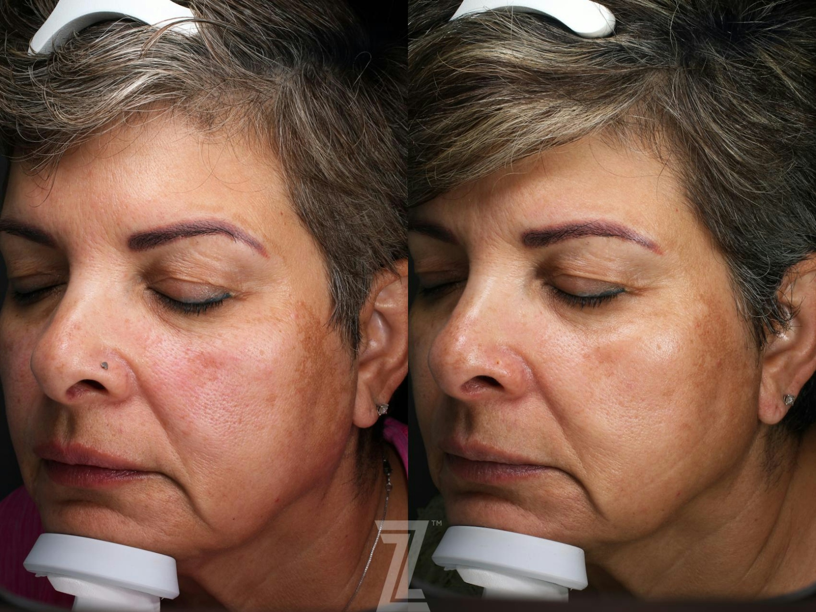 Austin Visia Skincare Analysis Before & After Gallery - Patient 132963266 - Image 1 - The Piazza Center