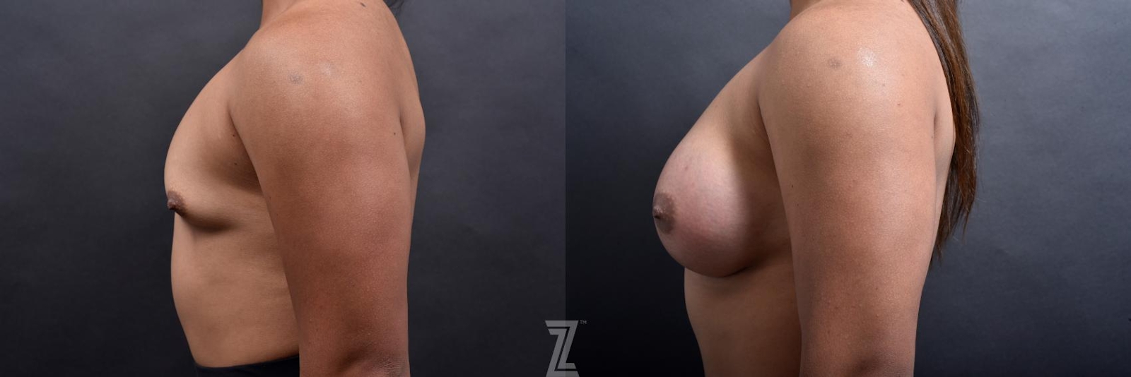 Austin Lateral view of before and after image 3 month post op 25 year old woman with Silicone Implants with Cohesive Silicone Gel - The Piazza Center