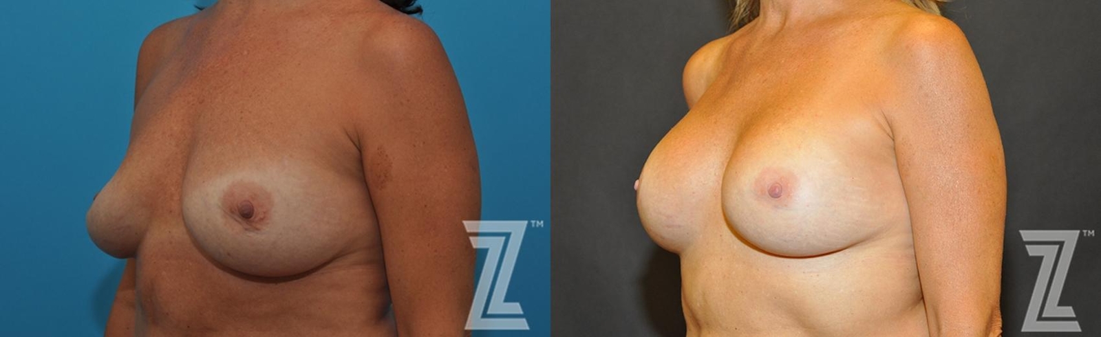 Austin Breast Augmentation Revision Before & After Gallery - Patient 132886563 - Image 2 - The Piazza Center