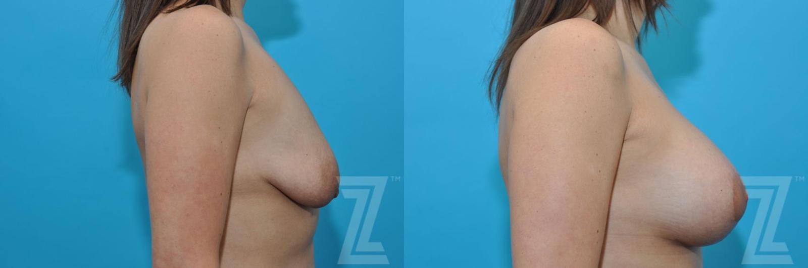 Austin Breast Augmentation With a Breast Lift Before & After Gallery - Patient 132791109 - Image 6 - The Piazza Center