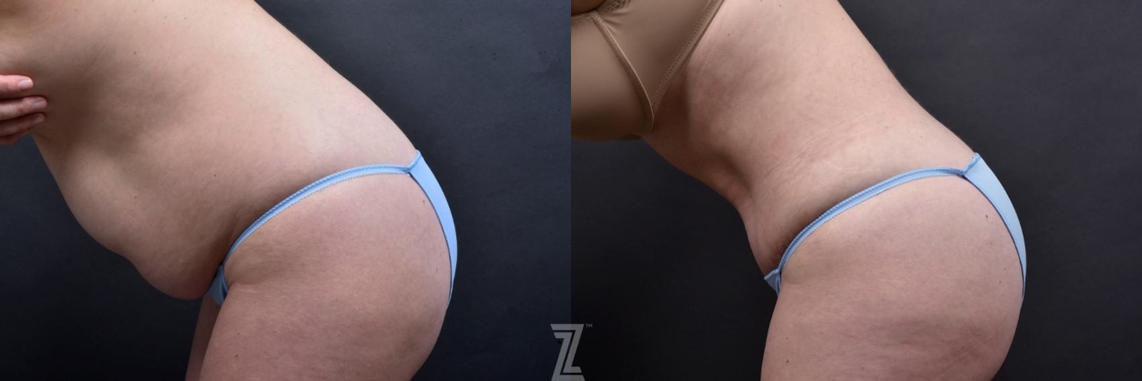 Austin Tummy Tuck Before & After Gallery - Patient 132886885 - Image 3 - The Piazza Center