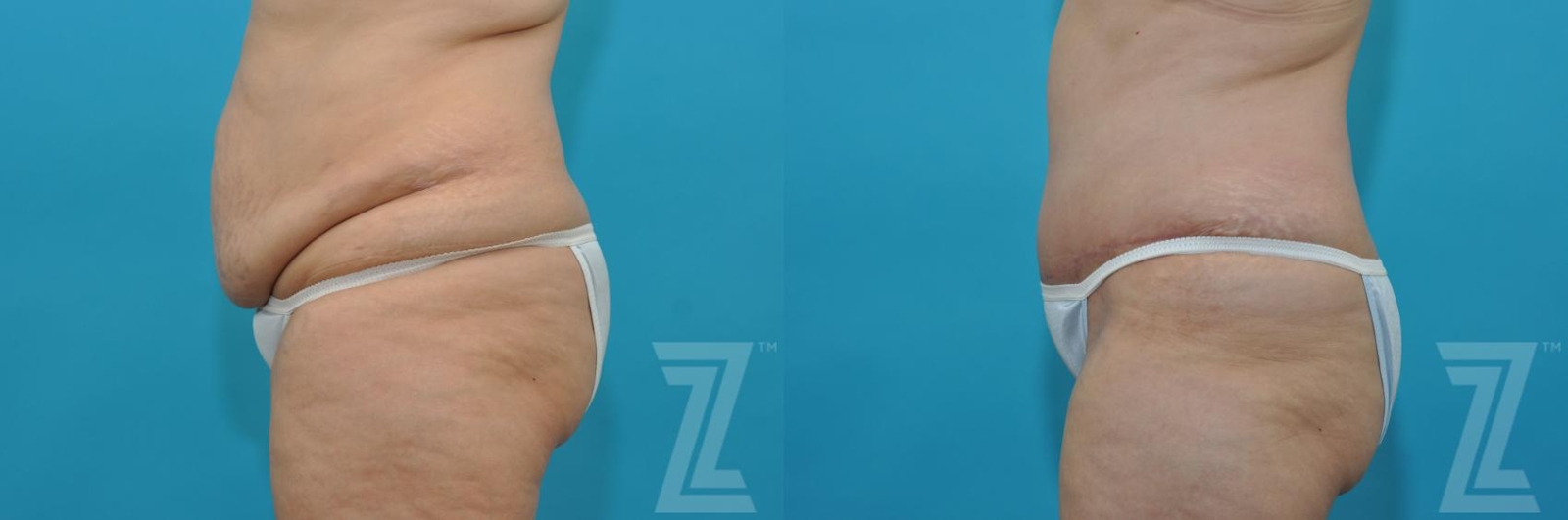 Austin Tummy Tuck Before & After Gallery - Patient 132886829 - Image 2 - The Piazza Center