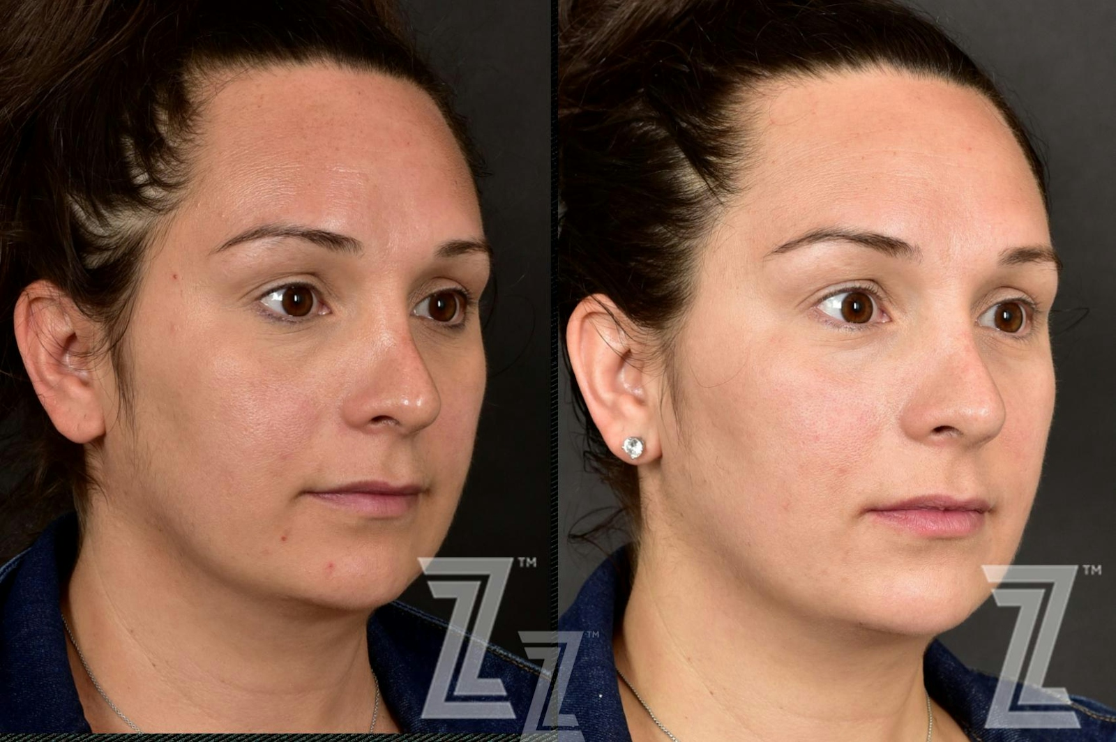 Austin HALO Before & After Gallery - Patient 132963258 - Image 2 - The Piazza Center