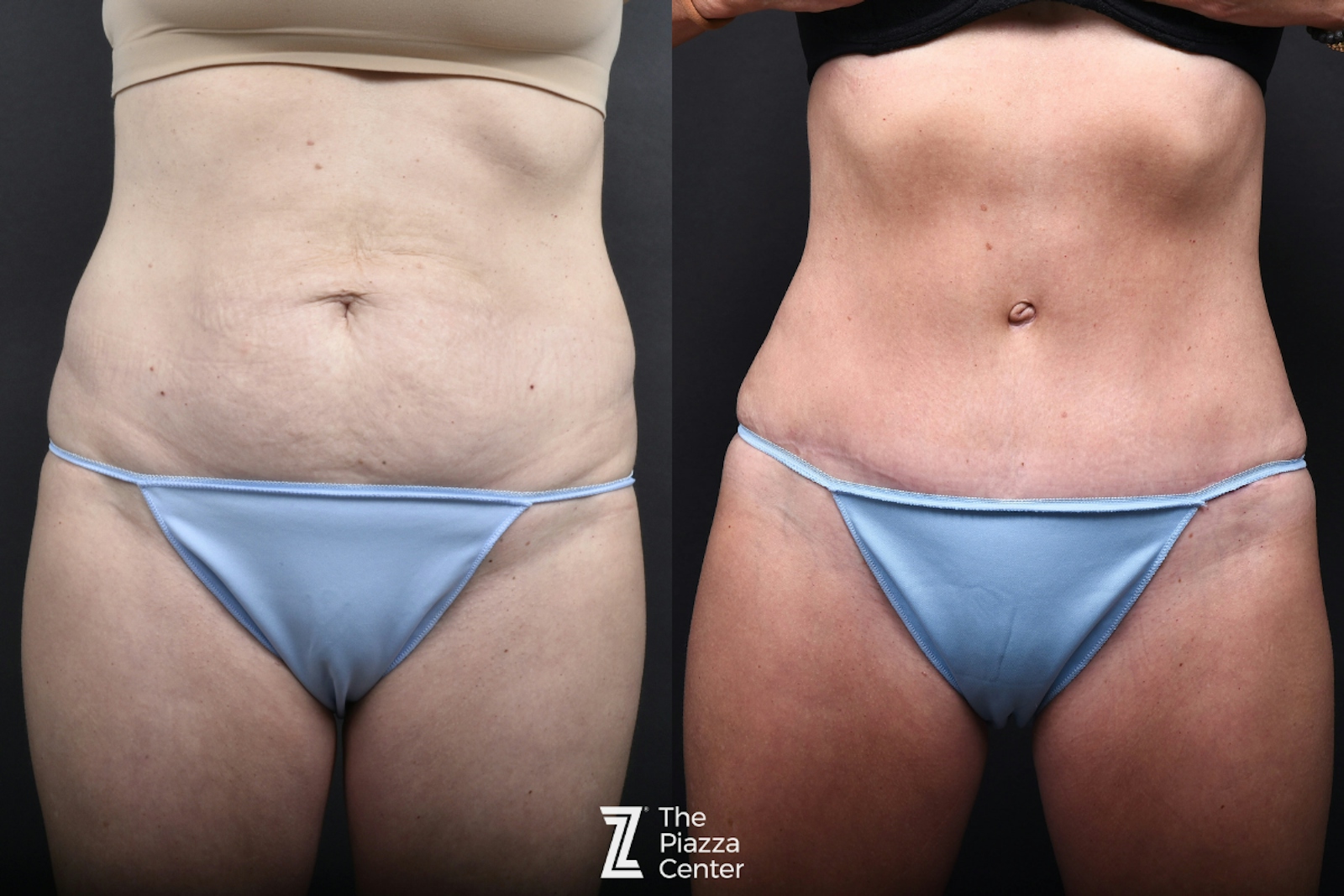 Austin Tummy Tuck Before & After Gallery - Patient 957209 - Image 1 - The Piazza Center