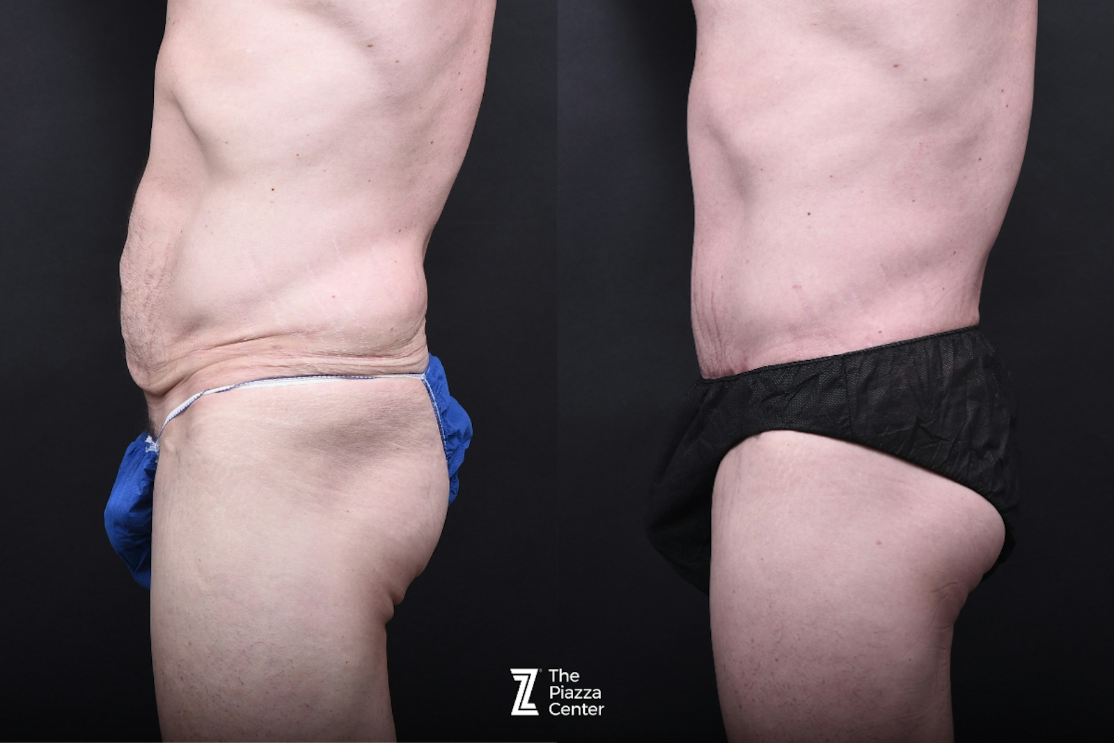 Austin Tummy Tuck Before & After Gallery - Patient 830228 - Image 4 - The Piazza Center