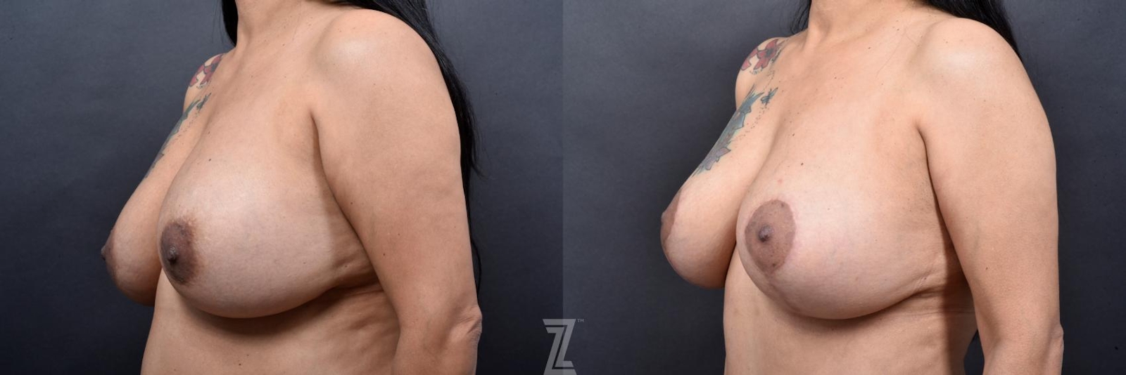 Austin 6 Month Post-OP Mommy Makeover in Austin, TX by Dr. Rocco Piazza - Oblique View of Breasts - The Piazza Center