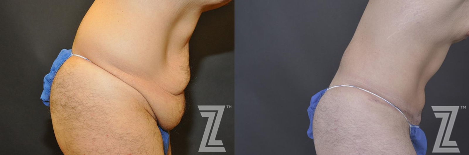 Austin Male Body Contouring Before & After Gallery - Patient 183281 - Image 5 - The Piazza Center