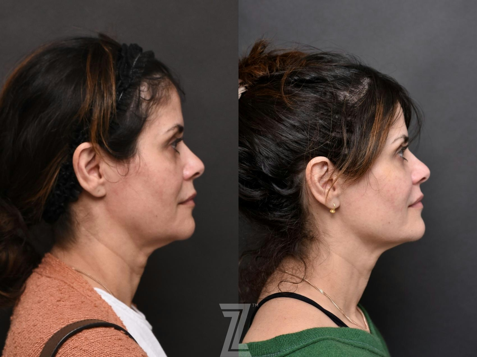 Austin Injectable Fillers Before & After Gallery - Patient 132946326 - Image 3 - The Piazza Center