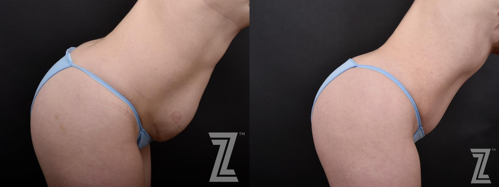 Austin Lateral View of Tummy in Flexion from Mommy Makeover with Surgical Plan for a Breast Augmentation and a Contoured Waistline With an Abdominoplasty in Austin, TX by Dr. Rocco Piazza - Before & After - Image - The Piazza Center