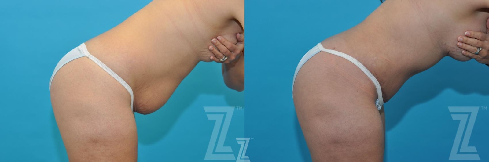 Austin Before & After images of 40-year-old mother of five mommy maker over oblique flexion view - Dr. Rocco Piazza, Austin TX - The Piazza Center