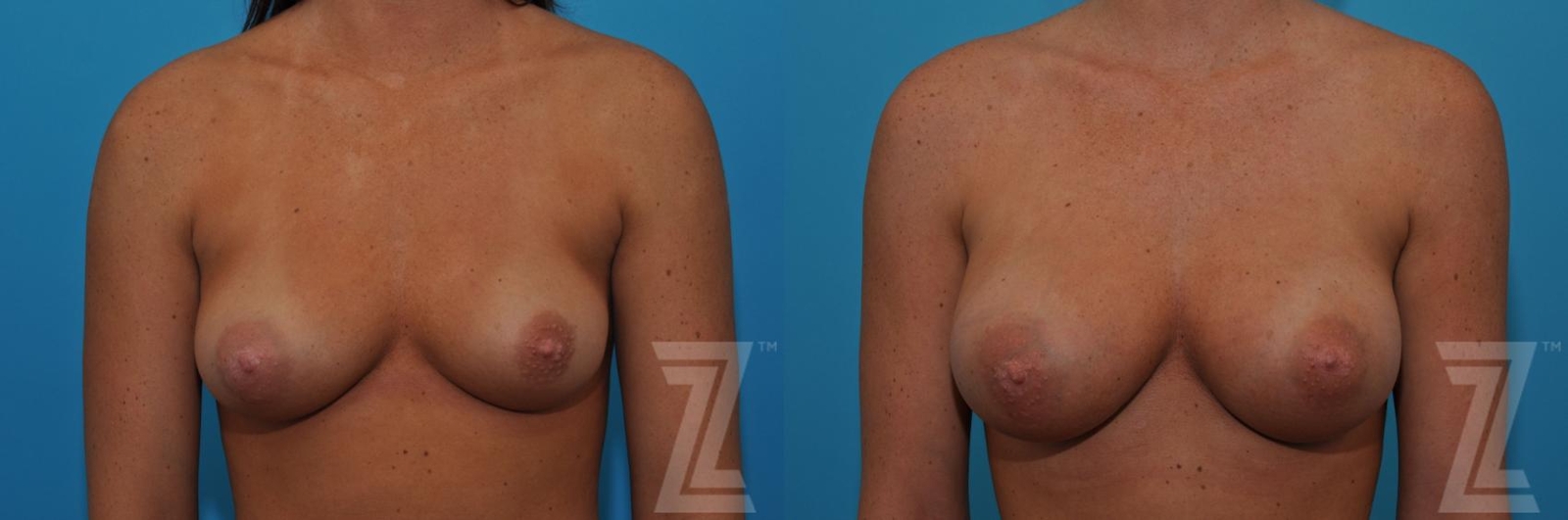 Austin Correction of Breast Asymmetry Before & After Gallery - Patient 132886779 - Image 1 - The Piazza Center