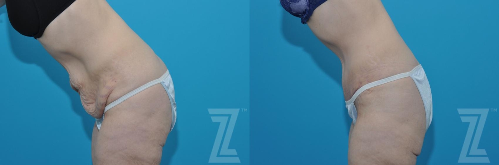 Austin Tummy Tuck Before & After Gallery - Patient 132886817 - Image 3 - The Piazza Center