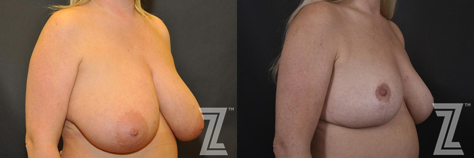 Austin Breast Reduction Before & After Gallery - Patient 132886746 - Image 4 - The Piazza Center