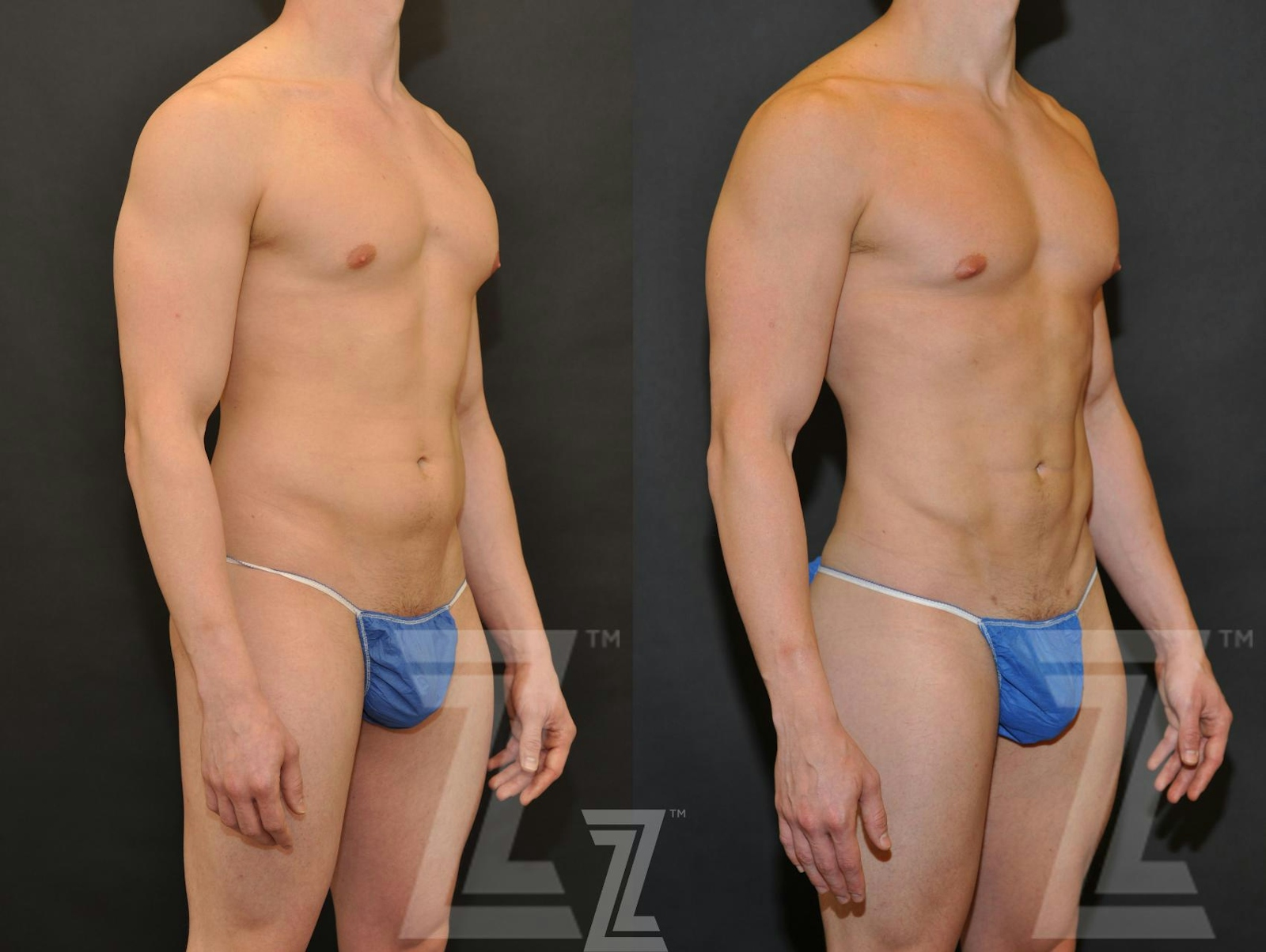 Austin Male Body Contouring Before & After Gallery - Patient 174118 - Image 4 - The Piazza Center