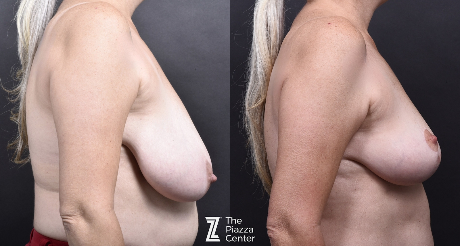 Austin Breast Lift Before & After Gallery - Patient 342651 - Image 3 - The Piazza Center