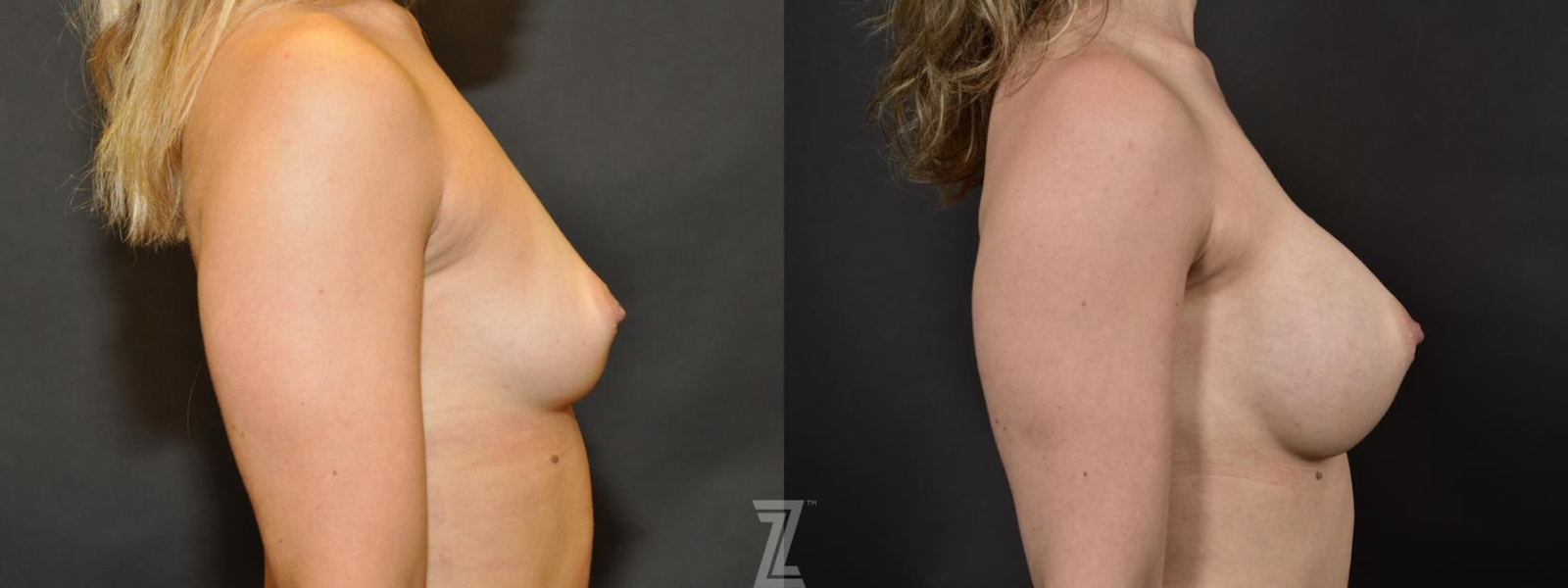 Austin Lateral Before & After image of 33 year old woman with Silicone Implants with Cohesive Silicone Gel - The Piazza Center