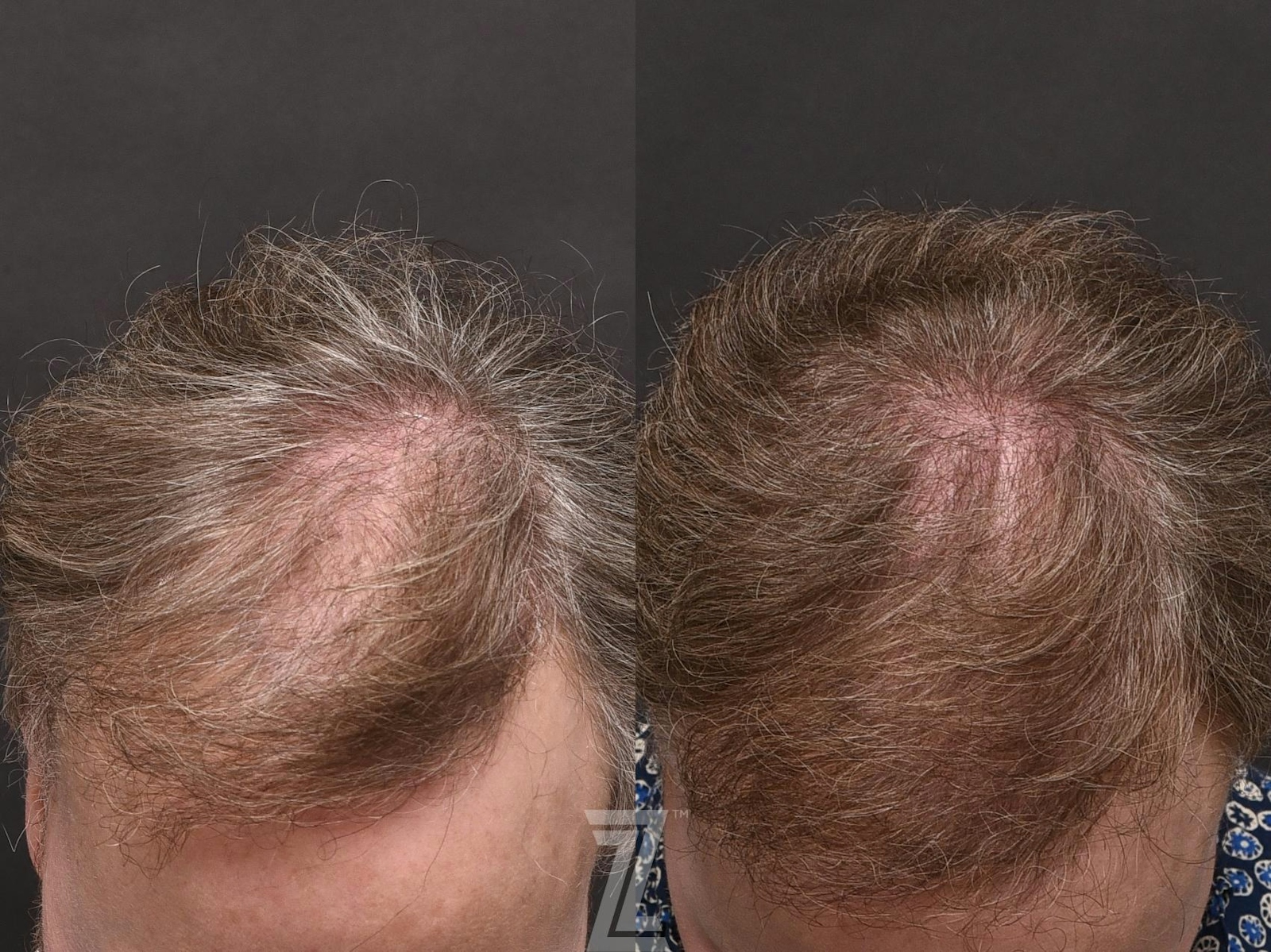 Austin Male Hair Restoration Before & After Gallery - Patient 336127 - Image 2 - The Piazza Center