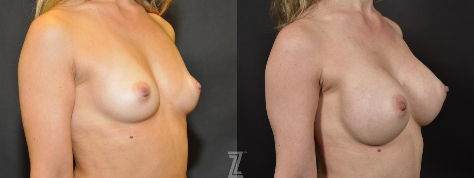 Austin Oblique Before & After image of 33 year old woman with Silicone Implants with Cohesive Silicone Gel - The Piazza Center