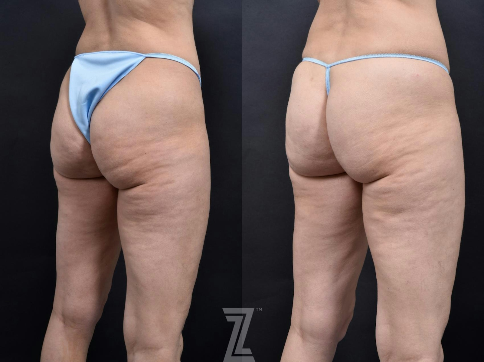 Austin Avéli Before & After Gallery - Patient 132905407 - Image 3 - The Piazza Center