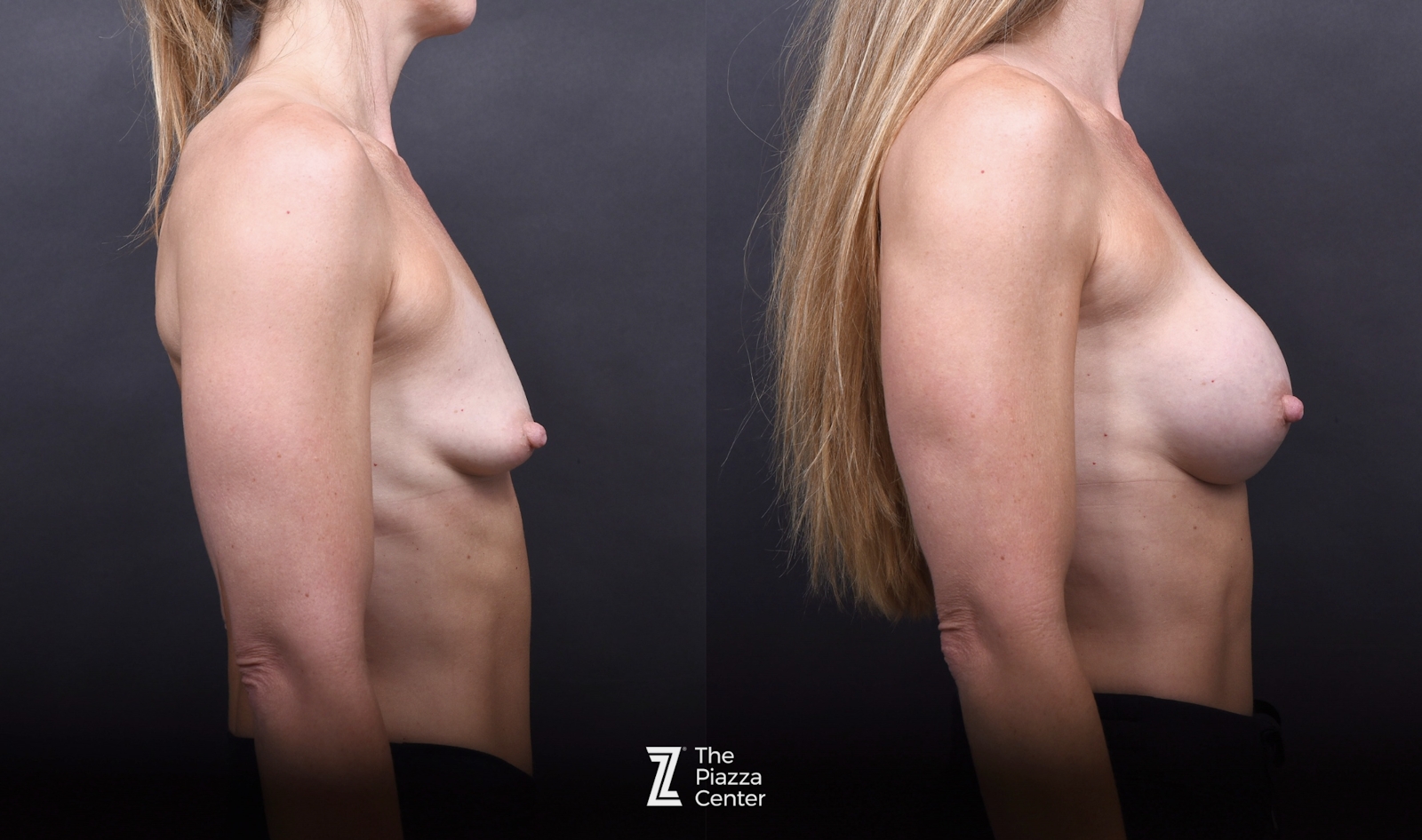 Austin Breast Augmentation Before & After Gallery - Patient 428919 - Image 3 - The Piazza Center