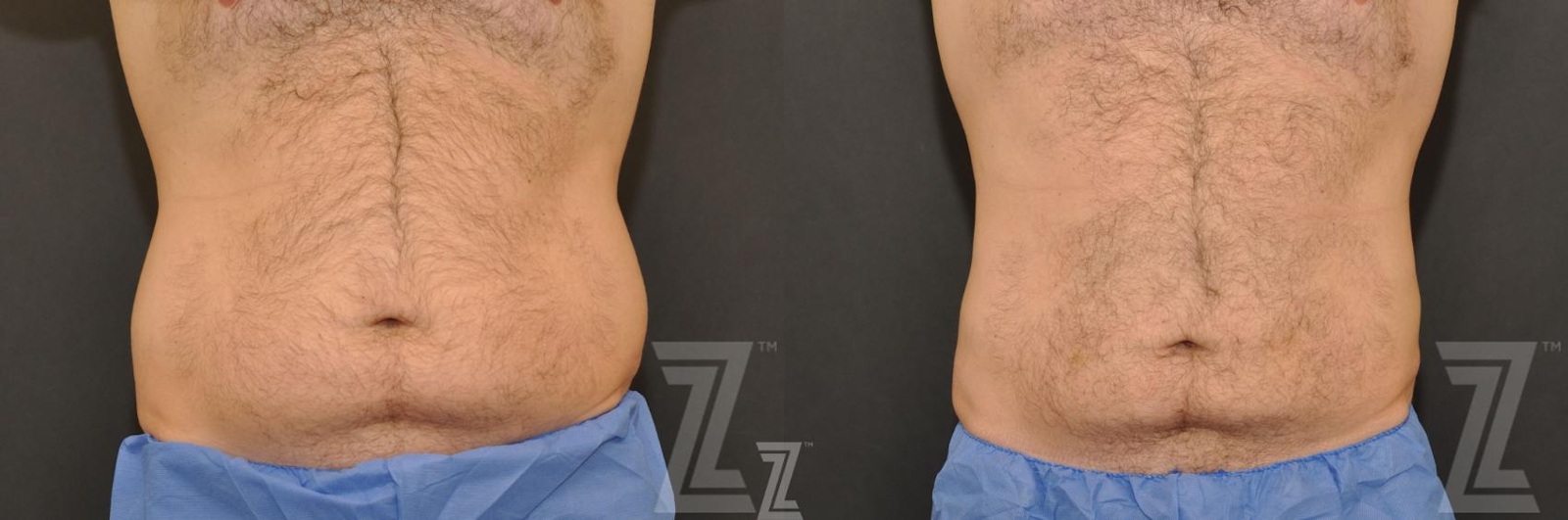 Austin CoolSculpting® Before & After Gallery - Patient 132905386 - Image 1 - The Piazza Center